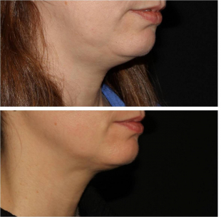 Kybella to Submental 